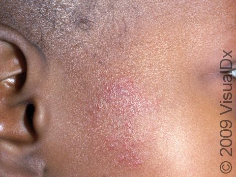 Early forms of fungal infections, such as this image displaying tinea faciale, can appear as a mild area of skin redness and scaling.