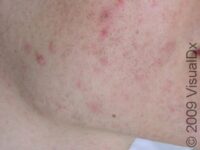 Acne Treatment, Laser – Cosmetics